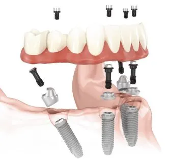 Illustration of an All-on-X full-arch dental implant restoration