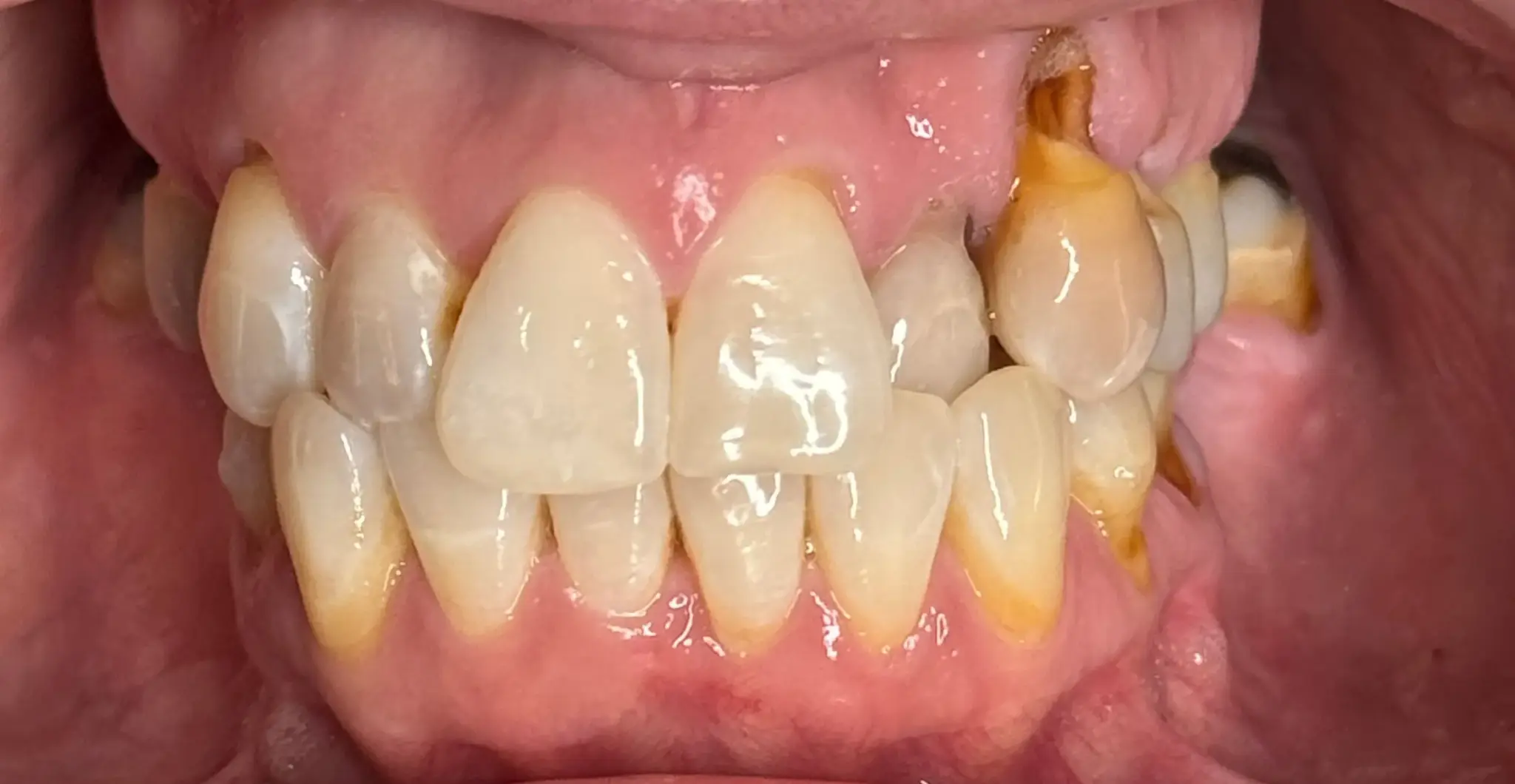Christie before implant and Invisalign treatment