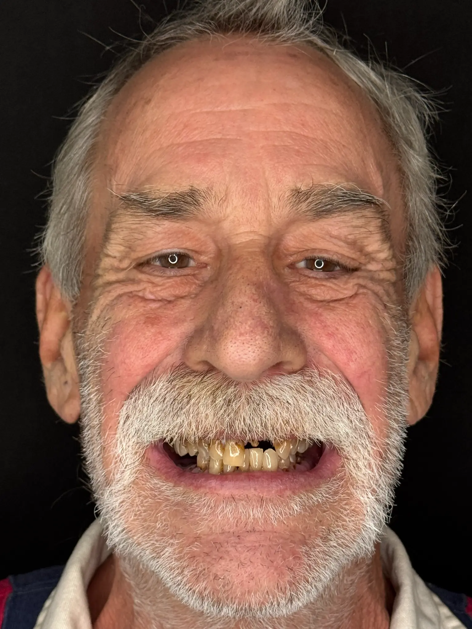 Craig Jones before upper and lower All-on-X treatment