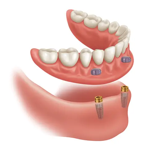 Illustration of an Essential Arch denture stabilization treatment