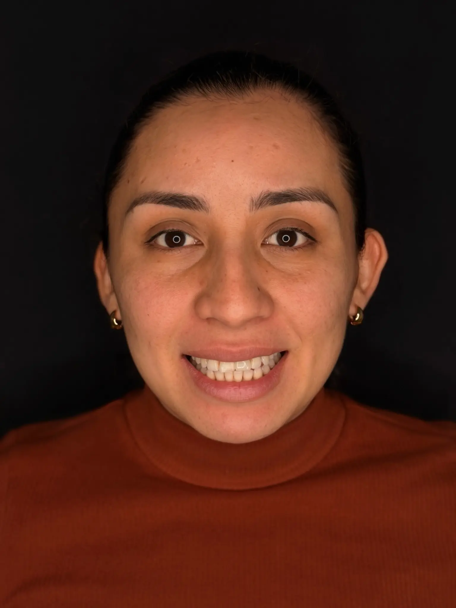 Marisol's smile after dental implant treatment