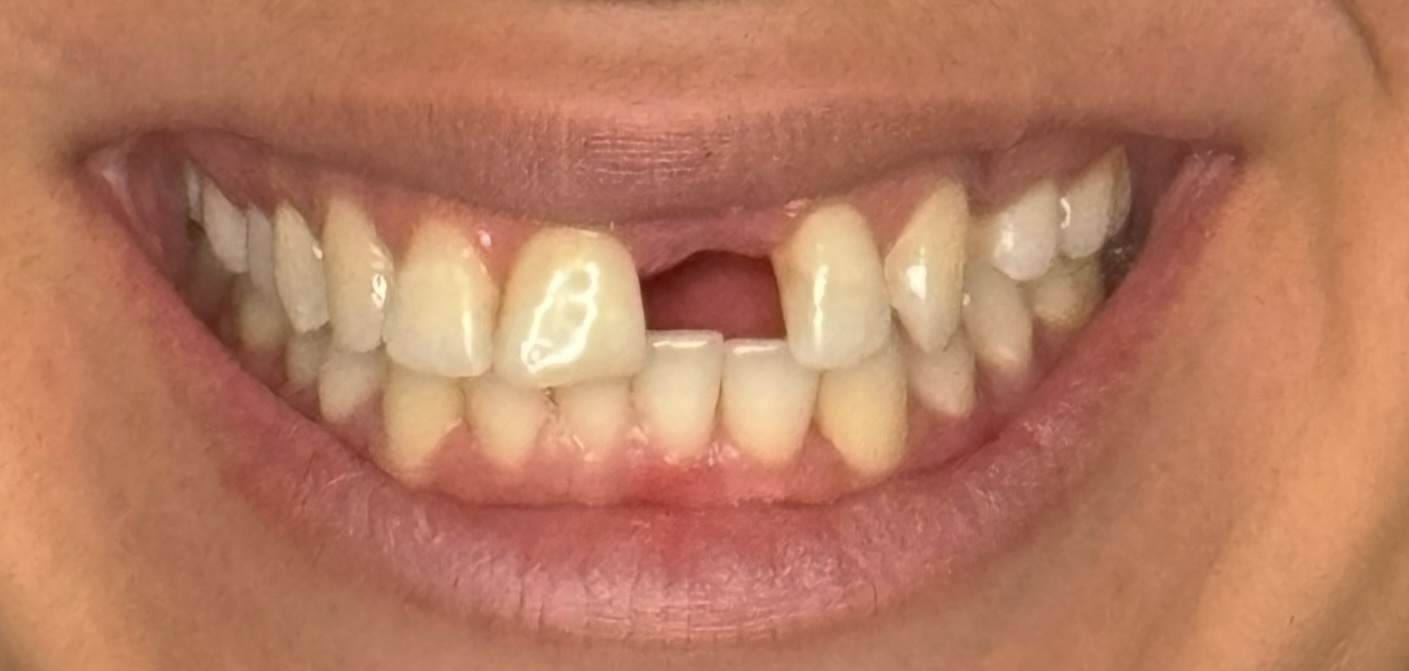 Marisol's smile before dental implant treatment