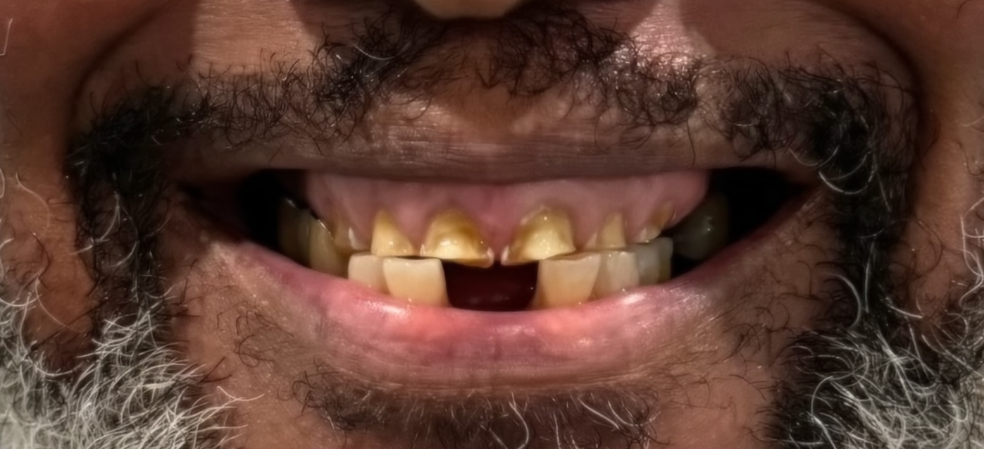 Pastor Andrew before dental implant treatment