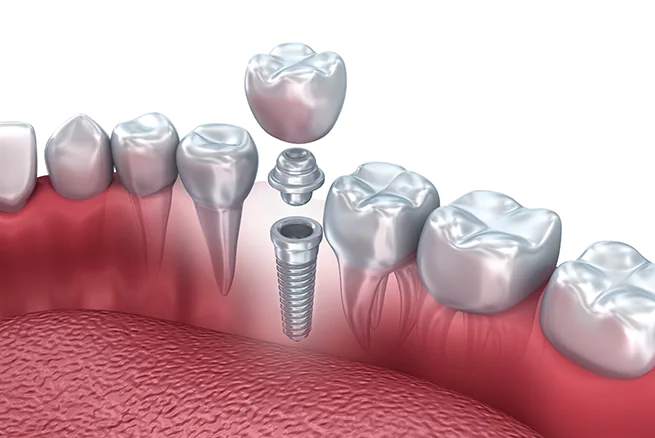 Illustration of a single dental implant with crown, abutment, and implant post